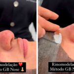 Vídeo: O que é rinomodelação, para quem é indicada e quanto tempo dura o efeito