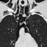 Jovem é internado na UTI após desenvolver condição pulmonar rara ao se mast...