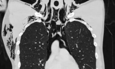 Jovem é internado na UTI após desenvolver condição pulmonar rara ao se mast...