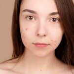 Acne fúngica: como identificar e tratar