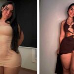 Método para eliminar celulites promete ajudar quem tem lipedema