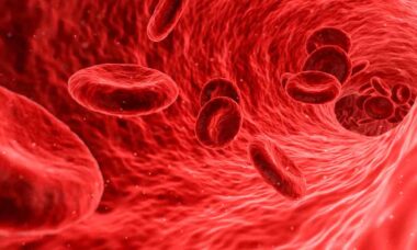 O que é anemia falciforme