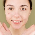 Dicas para se livrar das acnes rapidamente, de acordo com dermatologistas. Foto: pexels
