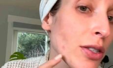 Vídeo: Dermatologista revela o tipo de espinha que você NUNCA deve espremer. Fotos e vídeos: Tiktok @drsamanthaellis