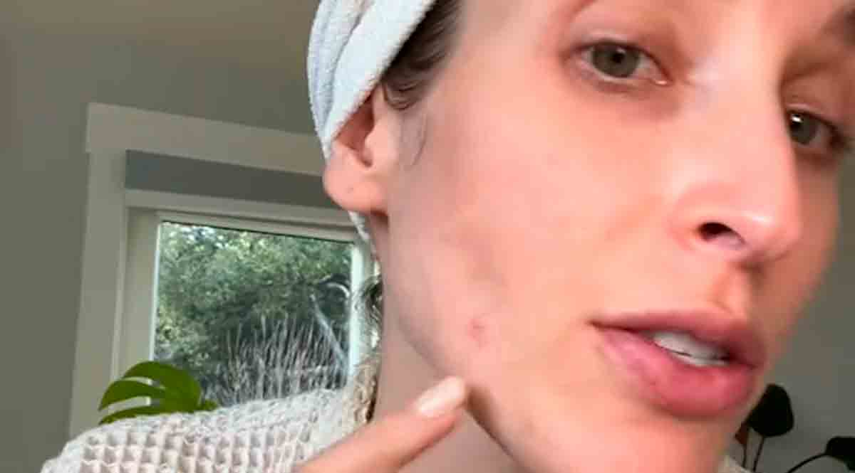 Vídeo: Dermatologista revela o tipo de espinha que você NUNCA deve espremer. Fotos e vídeos: Tiktok @drsamanthaellis